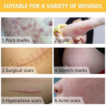 Load image into Gallery viewer, Home Laser Removal Pen for Tattoos Moles & Blemishes